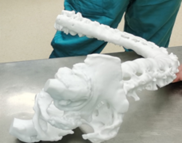 3D打印技术辅助下的高难度全髋关节置换术